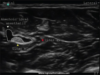 Figure 17b