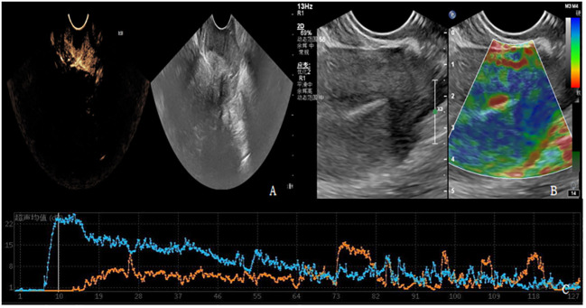 Contrast-enhanced Ultrasound Combined With Elastic Imaging For 