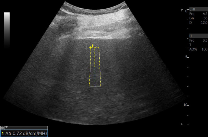 US image in a 72-year-old male patient with nonalcoholic steatohepatitis and grade 1 steatosis shows an example of US liver attenuation coefficient measurement. Higher attenuation values are expected with higher grades of steatosis. A region of interest is placed on an area without visible blood vessels. Attenuation value is presented on the bottom left of the image. Attenuation measurements are collected from the rectangular region of interest. Color map may be added to the region of interest if needed. Reproduced, with permission, from the Non-Invasive Biomarkers of Metabolic Liver Disease, or NIMBLE 1.1, study (18).