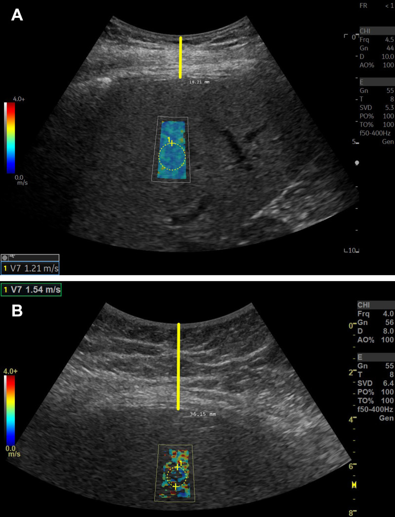 Shear-wave elastography (SWE) signal quality may be affected by the thickness of the subcutaneous tissue or skin-to–liver capsule distance. (A) SWE image in a 74-year-old female patient with clinically suspected nonalcoholic fatty liver disease (NAFLD). SWE examination was performed, and a complete SWE value pixel map was observed. The shear-wave speed, or SWS, color spectrum is presented on the left side (red, high SWS; dark blue, low SWS). Skin-to–liver capsule distance was estimated as 1.8 cm (vertical yellow line). The SWS value is presented in the bottom left corner of the image. SWS values are generated from the circular region of interest. (B) SWE image in a 35-year-old female patient with clinically suspected NAFLD. SWE examination was performed, and poor SWE value pixel map fill-in was observed. Skin-to–liver capsule distance was estimated as 3.6 cm (vertical yellow line). The SWS value is presented in the top left corner of the image. SWS values are generated from the circular region of interest.