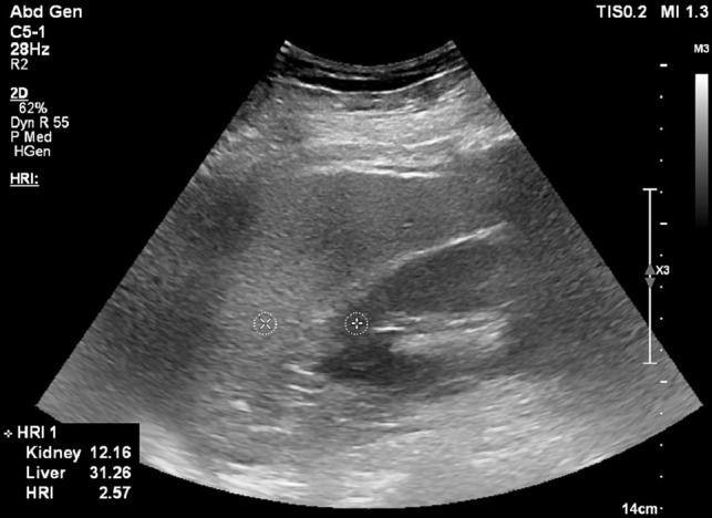 B-mode US image at the level of the pouch of Morison in a 59-year-old female patient with nonalcoholic steatohepatitis and grade 2 hepatic steatosis. Two circular regions of interest are placed on the kidney cortex and liver tissue at the same depth. Hepatorenal index (HRI) can be calculated on US systems with HRI quantification software, or images can be exported in Digital Imaging and Communications in Medicine, or DICOM, format and region of interest circles can be drawn with a DICOM viewer. In this image, the local region of interest pixel brightness values and the HRI value are presented in the bottom left corner. Reproduced, with permission, from the Non-Invasive Biomarkers of Metabolic Liver Disease, or NIMBLE 1.1, study (18).