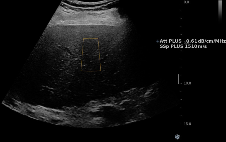 US image in a 64-year-old male patient with nonalcoholic steatohepatitis cirrhosis and grade 1 steatosis. Speed of sound (SSp PLUS) and attenuation (Att PLUS) values are shown. The measurements are collected from the rectangular region of interest. Lower speed of sound values are expected with increasing steatosis. Reproduced, with permission, from the Non-Invasive Biomarkers of Metabolic Liver Disease, or NIMBLE 1.1, study (18).