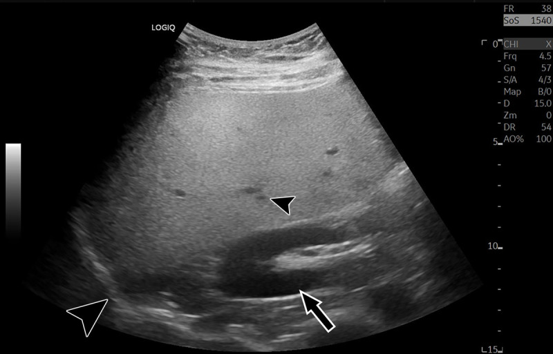 Characteristic B-mode US image in a 35-year-old male patient with hepatic steatosis and 16% MRI proton density fat fraction. Steatosis results in increased brightness of the liver relative to the kidney (arrow), blurring of hepatic vasculature (small arrowhead), loss of definition of the diaphragm (large arrowhead), and reduced signal from deep anatomy.