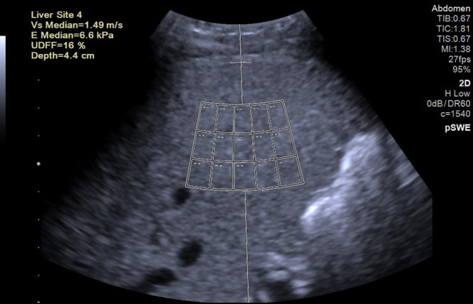 US image in a 55-year-old female patient with nonalcoholic steatohepatitis and grade 1 steatosis. Point shear-wave elastography (pSWE) and US-derived fat fraction (UDFF) measurements are presented. The device software uses a large region of interest with 15 small measurement locations (rectangles). In this method, attenuation and backscatter coefficients are combined to report a single value in percentage unit. Higher US-derived fat fraction values are expected with increasing steatosis. The US-derived fat fraction and shear-wave speed values (top left corner) are acquired by these 15 small regions of interest. The purpose of using 15 small regions of interest is to expand the measurement area. Reproduced, with permission, from the Non-Invasive Biomarkers of Metabolic Liver Disease, or NIMBLE 1.1, study (18).