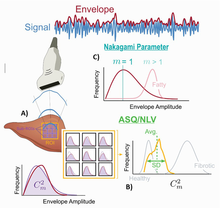 Diagram shows liver fat quantification with the acoustic structure quantification (ASQ), normalized local variance (NLV), and Nakagami parameter methods. (A) ASQ and NLV are calculated by comparing the theoretical and real envelope distributions of backscattered US signal (purple and red distribution curves). The magnitude of the fitting between these two curves is calculated as the Cm2 value. This value is calculated in multiple small regions of interest (ROIs). (B) The distribution of these multiple Cm2 values is plotted. The ASQ method uses the differences between these plots to differentiate fibrotic tissue. NLV is calculated according to similar principles; however, it is mainly used for steatosis quantification. (C) The Nakagami parameter is the variation in the shape of the envelope distribution of backscattered US signal (red distribution on the blue curve). This variation is estimated as the m value, which is also called shape parameter. Higher m values are observed in fatty liver tissues.