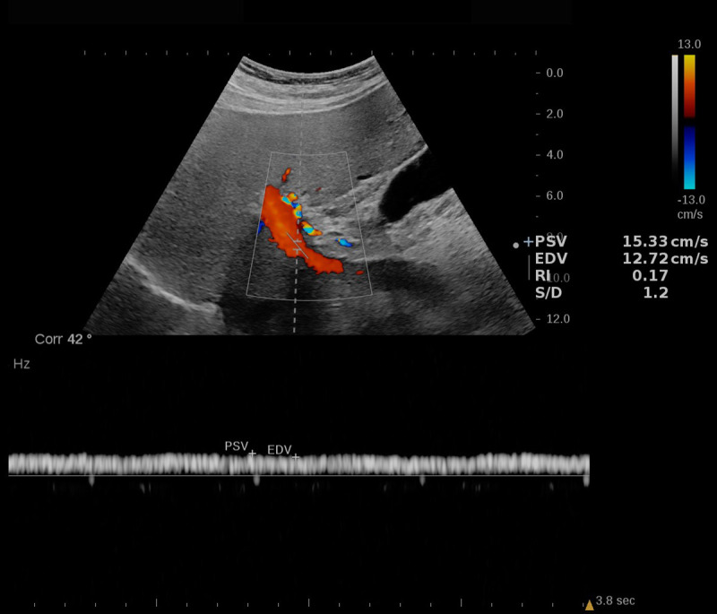 Doppler US image in a 72-year-old male patient with nonalcoholic steatohepatitis (NASH) and grade 1 steatosis. An example of a portal vein spectral Doppler image with flow speed maximum of 15.33 cm/sec and minimum of 12.72 cm/sec. The colored scale bar on the left represents the flow speed spectrum based on the flow direction. The graph on the bottom represents the Doppler spectrum and its association with flow velocity. Increased portal vein pulsatility index [(maximum velocity – minimum velocity)/maximum velocity] may be associated with NASH (46). Reproduced, with permission, from the Non-Invasive Biomarkers of Metabolic Liver Disease, or NIMBLE 1.1, study (18).