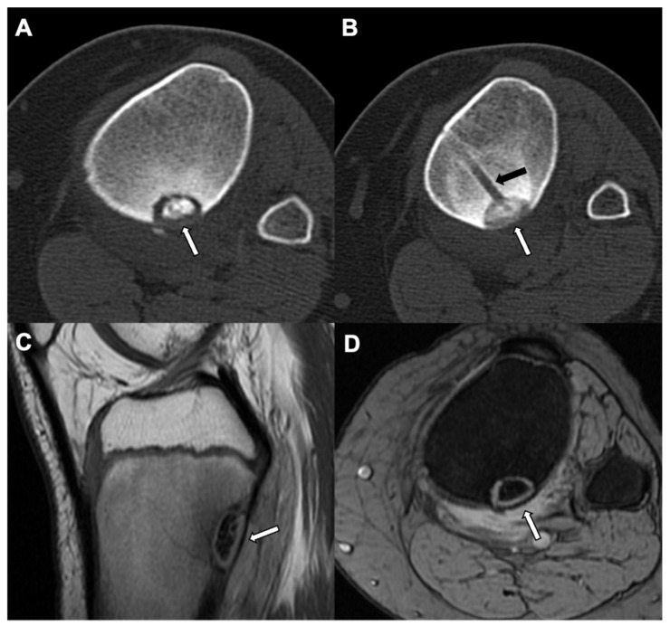 Imaging Review of Pediatric Benign Osteocytic Tumors and Latest Updates ...