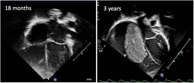 Innocent until proven guilty? Longstanding atrial ectopy preceding ...