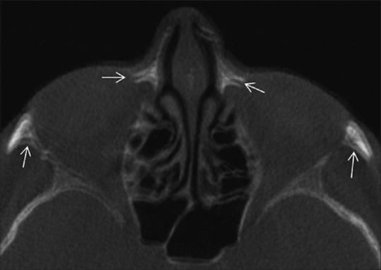 Artifacts: The downturn of CBCT image - PMC