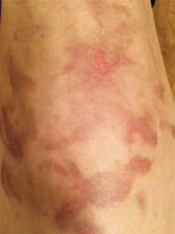 Phytophotodermatitis: Rash with many faces - PMC