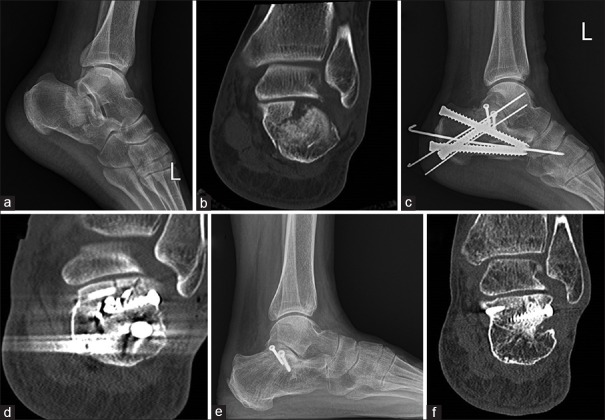 Surgical Treatment Of Sanders Type 2 Calcaneal Fractures Using A Sinus