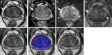 Axial multiparametric MRI scans in a 72-year-old male participant with
a serum prostate-specific antigen level of 9.1 ng/mL: (A) T2-weighted image,
(B) apparent diffusion coefficient map, (C) high-b-value diffusion-weighted
image (b = 1500 sec/mm2), (D) dynamic contrast-enhanced image (frame 17 of
54 acquired at 5.6-second intervals), (E) T2-weighted image with
radiologist-segmented lesions (green contours) overlaid, (F) T2-weighted
image with artificial intelligence (AI) prediction map overlaid (red contour
is positive prediction; blue contour is AI prostate organ segmentation), and
(G) T2-weighted image with AI probability map overlaid (red indicates higher
probability). Two distinct lesions were detected by the radiologist and
represented the ground truth. Lesion 1 (1.6 cm; arrow in A–D) was in
the right midgland transition zone and was designated Prostate Imaging
Reporting and Data System (PI-RADS) category 4. Lesion 2 (1.5 cm; arrowhead
in A–D) was in the left midgland transition zone and was designated
PI-RADS category 3. Lesion 1 was correctly detected (true positive), while
lesion 2 was missed by the AI algorithm (false negative). Based on targeted
biopsy samples, lesion 1 was positive for Gleason score 7 (3 + 4) prostate
adenocarcinoma, and lesion 2 was benign.
