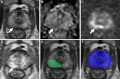 Axial multiparametric MRI scans in a 74-year-old male participant with
a serum prostate-specific antigen level of 12.9 ng/mL: (A) T2-weighted
image, (B) apparent diffusion coefficient map, (C) high-b-value
diffusion-weighted image (b = 1500 sec/mm2), (D) dynamic contrast-enhanced
image (frame 16 of 54 acquired at 5.6-second intervals), (E) T2-weighted
image with radiologist-segmented lesion (green contour) overlaid, and (F)
T2-weighted image with artificial intelligence (AI) prediction map overlaid
(no positive prediction; blue contour is AI prostate organ segmentation).
One lesion was detected by the radiologist and represented the ground truth.
The lesion (1.9 cm; arrow in A–D) was in the right apical midgland
peripheral zone and was designated Prostate Imaging Reporting and Data
System category 4. This lesion was missed by the AI algorithm, representing
a false negative. A targeted biopsy sample obtained from the lesion was
positive for Gleason score 7 (3 + 4) prostate adenocarcinoma.