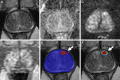 Axial multiparametric MRI scans in a 69-year-old male participant with
a serum prostate-specific antigen level of 7.3 ng/mL: (A) T2-weighted image,
(B) apparent diffusion coefficient map, (C) high-b-value diffusion-weighted
image (b = 1500 sec/mm2), (D) dynamic contrast-enhanced image (frame 25 of
54 acquired at 5.6-second intervals), (E) T2-weighted image with artificial
intelligence (AI) prediction map overlaid (red contour is positive
prediction; blue contour is AI prostate organ segmentation), and (F)
T2-weighted image with AI probability map overlaid (red indicates higher
probability). One lesion was called by the AI algorithm in the left midgland
anterior transition zone (arrow in E and F), representing a false positive
based on the radiologist ground truth. A systematic biopsy sample obtained
from this site (left midgland medial) was benign.