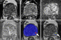 Axial multiparametric MRI scans in a 64-year-old male participant with
a serum prostate-specific antigen level of 8.1 ng/mL: (A) T2-weighted image,
(B) apparent diffusion coefficient map, (C) high-b-value diffusion-weighted
image (b = 1500 sec/mm2), (D) dynamic contrast-enhanced image (frame 45 of
54 acquired at 5.6-second intervals), (E) T2-weighted image with artificial
intelligence (AI) prediction map overlaid (red contour is positive
prediction; blue contour is AI prostate organ segmentation), and (F)
T2-weighted image with AI probability map overlaid (red indicates higher
probability). No distinct lesion was detected by the radiologist (Prostate
Imaging Reporting and Data System category 1). One lesion was called by the
AI algorithm in the left midgland peripheral zone (arrow in E and F),
representing a false positive based on the radiologist ground truth.
Systematic biopsy obtained from this site (left midgland lateral) was
positive for Gleason score 7 (3 + 4) prostate adenocarcinoma.