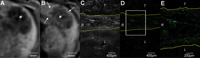 In vivo molecular imaging of peritumoral antigen-presenting immune cell infiltrate using gadolinium 160 (160Gd)–labeled anti–human leukocyte antigen–DR isotope (HLA-DR) antibodies. A, Baseline T1-weighted axial MRI scan of VX2 liver tumor (*). B, Peritumoral rim enhancement (arrows) on T1-weighted axial Dixon MRI scan (repetition time, 5.19 msec; echo times, 2.46 and 3.69 msec) obtained 24 hours after intra-arterial administration of 160Gd-labeled anti–HLA-DR antibody indicates peritumoral immune cell infiltrate. * = tumor. C, Bright field image and, D, E, colored images from ex vivo imaging mass cytometry of tissue harvested from the rabbit in A and B after ablation of 160Gd (160Gd in green) confirm deposition of 160Gd-labeled anti–HLA-DR antibody in the peritumoral rim. The box in D indicates the the area of magnification for E. L = liver, R = peritumoral rim, T = tumor.