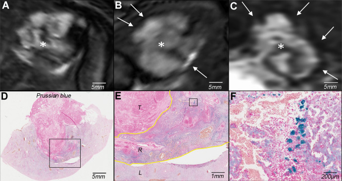 In vivo molecular imaging of superparamagnetic iron oxide nanoparticles (SPIONs) reveals macrophage infiltration in the peritumoral rim. A, Baseline T2-weighted fat-suppressed axial spin-echo MRI scan (repetition time msec/echo time msec, 1000/78) of VX2 liver tumor (*). B, T2-weighted axial and, C, coronal MRI scans obtained 24 hours after SPION administration show hypointense peritumoral rim (arrows) indicative of peritumoral retention of iron. * = tumor. D–F, Photomicrographs of iron (Prussian blue stain) reveal deposition of SPIONs primarily in the peritumoral rim at, D, ×1 and, E, ×5 magnification after phagocytosis by macrophages as seen at, F, ×20 magnification. The boxes in D and E indicate areas of magnification for E and F, respectively. The yellow lines in E outline the peritumoral rim. L = liver, R = peritumoral rim, T = tumor.