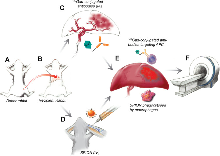 Diagram illustrates the experimental design of immune cell imaging in vivo. A, VX2 liver tumor chunks were injected into the hind leg of a donor rabbit. B, Tumor chunks were harvested and injected into the left liver of the recipient rabbit and allowed to grow for 14 days. C, Three rabbits received intra-arterial (IA) injections of gadolinium 160 (160Gd)–labeled anti–human leukocyte antigen–DR isotope antibodies and, D, three were intravenously (IV) injected with superparamagnetic iron oxide nanoparticles (SPION). E, 160Gd-conjugated antibodies target antigen-presenting immune cells (APC) in the peritumoral rim and SPIONs are phagocytosed by peritumoral macrophages. F, MRI was performed and imaging findings were confirmed with radiologic-pathologic correlation.