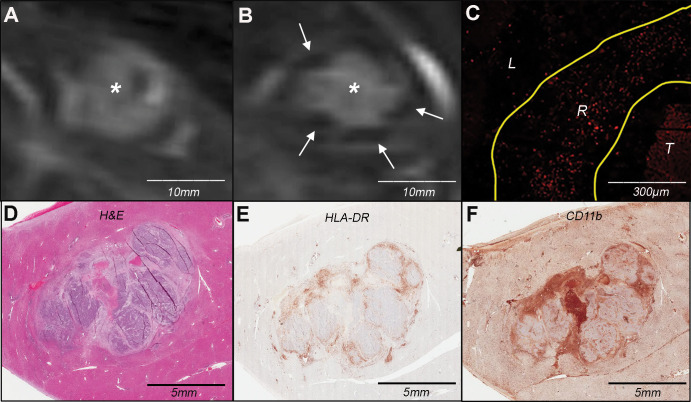 Molecular imaging of cellular uptake of rhodamine-conjugated superparamagnetic iron oxide nanoparticles (SPIONs) in peritumoral macrophages. A, Baseline T2-weighted fat-suppressed axial spin-echo MRI scan (repetition time msec/echo time msec, 1000/78) of VX2 liver tumor (*). B, Hypointense peritumoral rim demarcation (arrows) on T2-weighted axial MRI scan obtained 24 hours after administration of rhodamine-conjugated SPIONs indicates peritumoral retention. * = tumor. C, Immunofluorescence image of rhodamine on tissue harvested from the same rabbit confirms deposition of SPIONs in the peritumoral rim (outlined by yellow lines). L = liver, R = peritumoral rim, T = tumor. D, Photomicrograph (hematoxylin-eosin [H&E] stain) of VX2 tumor and surrounding liver. E, F, Immunohistochemistry with, E, anti–human leukocyte antigen–DR isotope (HLA-DR) and, F, anti-CD11b antibodies reveals antigen-presenting immune cells and macrophages in the peritumoral rim, respectively.