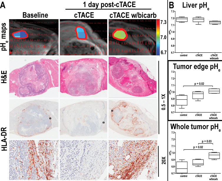 A, Images demonstrate that normalization of extracellular tumor pH (pHe) neutralizes inherent tumor acidosis and restores immune permissiveness after conventional transarterial chemoembolization (TACE) (cTACE). Top, peaks from extracellular pH spectroscopy are shown in red, overlaid on the corresponding anatomic T1-weighted axial MRI scans (repetition time msec/echo time msec, 5.2/2.5). Color map overlays illustrate extracellular tumor pH. Middle, Hematoxylin-eosin (H&E) and, bottom, human leukocyte antigen–DR isotope (HLA-DR) receptor staining reveals peritumoral immune cell infiltration in acidic untreated tumors. While extracellular tumor pH changes after conventional TACE remained insignificant and immune cell infiltrates were similar to or decreased compared with untreated tumors, conventional TACE with bicarbonate (cTACE w/bicarb) significantly increased extracellular pH of the tumor and tumor edge, boosting peritumoral immune cell infiltration. B, Box-and-whisker plots indicate extracellular (pHe) differences in control rabbits and those treated with conventional TACE (cTACE) and conventional TACE with bicarbonate (cTACE w/bicarb). Data are medians (lines in boxes) and 25th to 75th percentiles (bottom and top of boxes) and ranges (whiskers) (Mann-Whitney U, Kruskal-Wallis test).