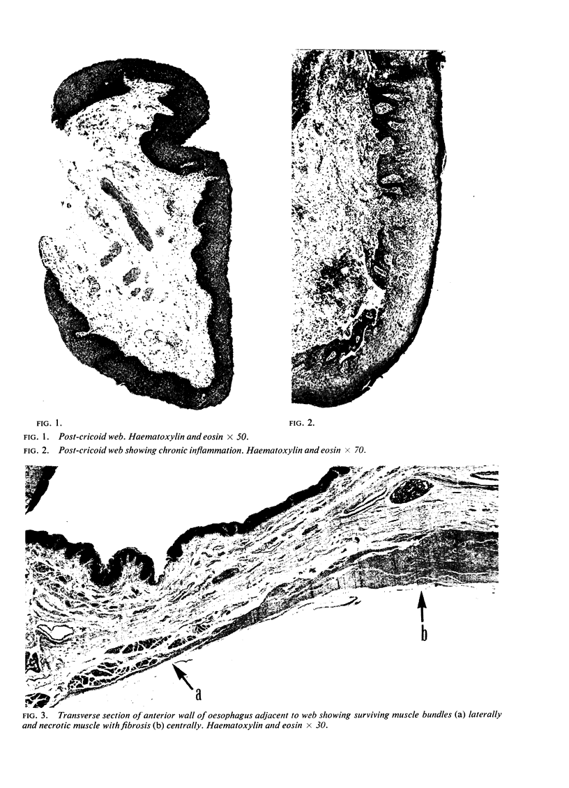 histological-findings-in-the-paterson-kelly-syndrome-pmc