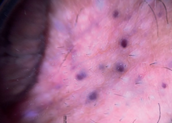 Genital angiokeratoma in a woman with Fabry disease: the dermatologist ...