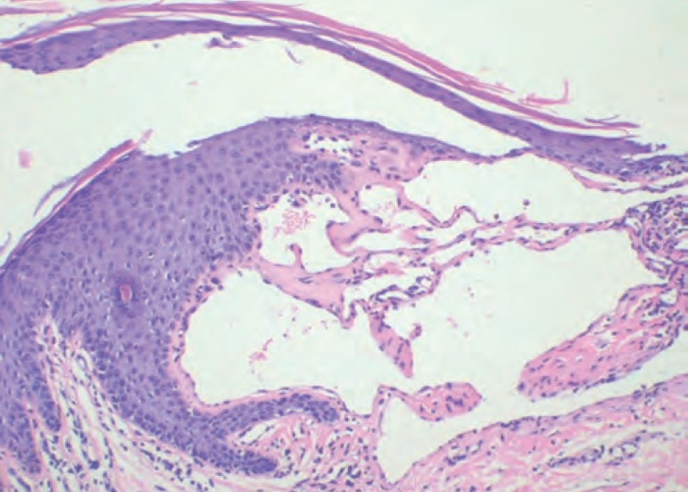 Genital angiokeratoma in a woman with Fabry disease: the dermatologist ...