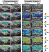 Representative B-mode US and quantitative US (QUS) spectral parametric
images of average scatterer diameter (ASD), average acoustic concentration
(AAC), midband fit (MBF), spectral slope (SS), and spectral intercept (SI)
in one participant (a 74-year-old woman) with complete response (left two
columns) and one participant (a 61-year-old man) with incomplete response
(right two columns) acquired at baseline (before radiation therapy) and
after week 1 of radiation therapy. QUS parametric images include the largest
involved cervical lymph node (central region bounded by closed dotted white
curve). The color bar range is 160 µm for ASD, 130 dB/cm3 for AAC, 40
dB for MBF, 12 dB/MHz for SS, and 75 dB for SI. The scale bar represents 1
cm.
