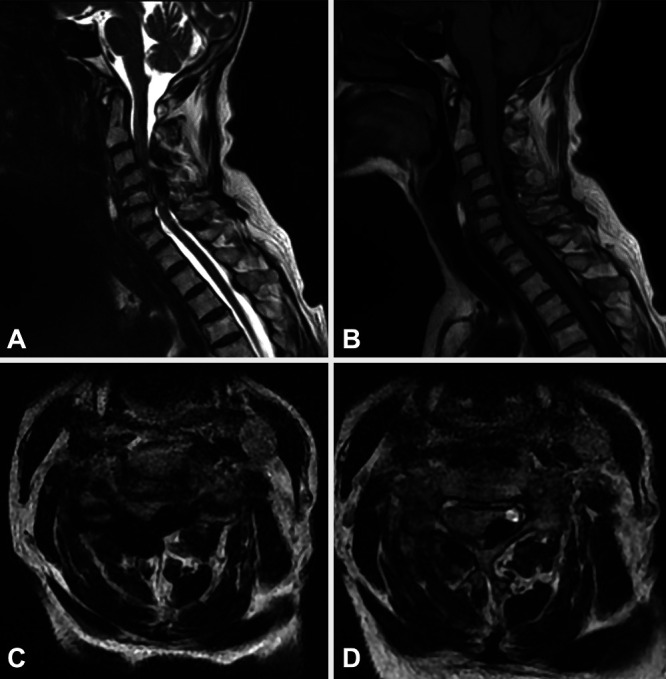 Systemic sclerosis-associated compressive cervical calcinosis ...