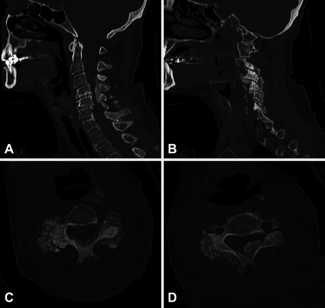 Systemic sclerosis-associated compressive cervical calcinosis ...