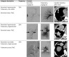 Diagram of blood supply to lung metastases (arrows). Tumors were
classified into three categories, according to their appearance at
angiography. TACE = transarterial chemoembolization.