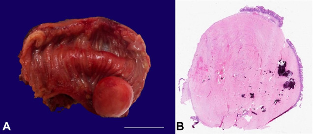 Calcifying fibrous tumor - PMC