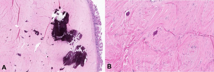 Calcifying fibrous tumor - PMC