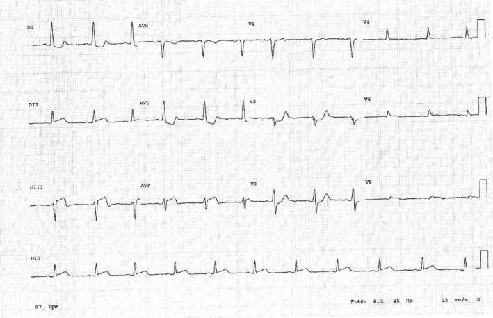 Concealed Wolff–parkinson–white Syndrome Revealed By Acute Coronary 