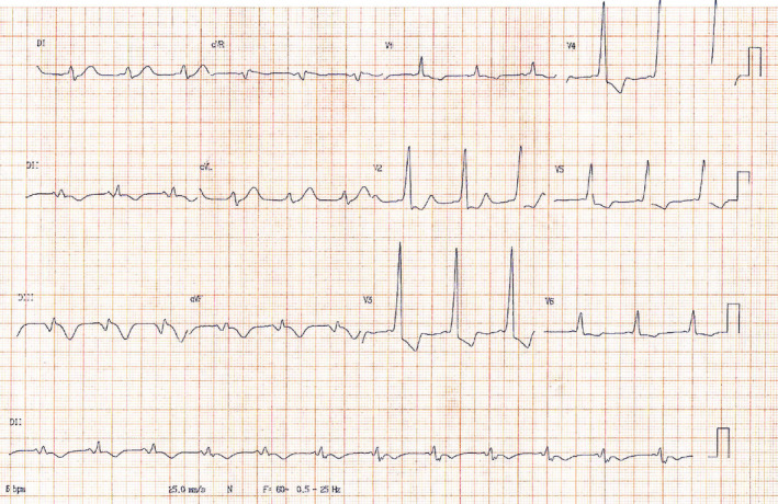 Concealed Wolff–parkinson–white Syndrome Revealed By Acute Coronary 