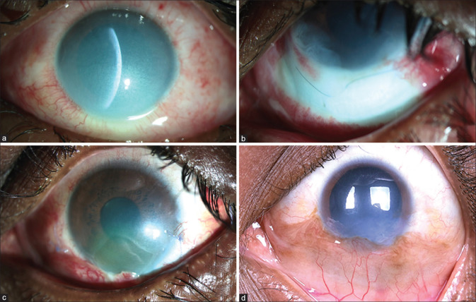 The role of Tenonplasty in the management of limbal and scleral ...