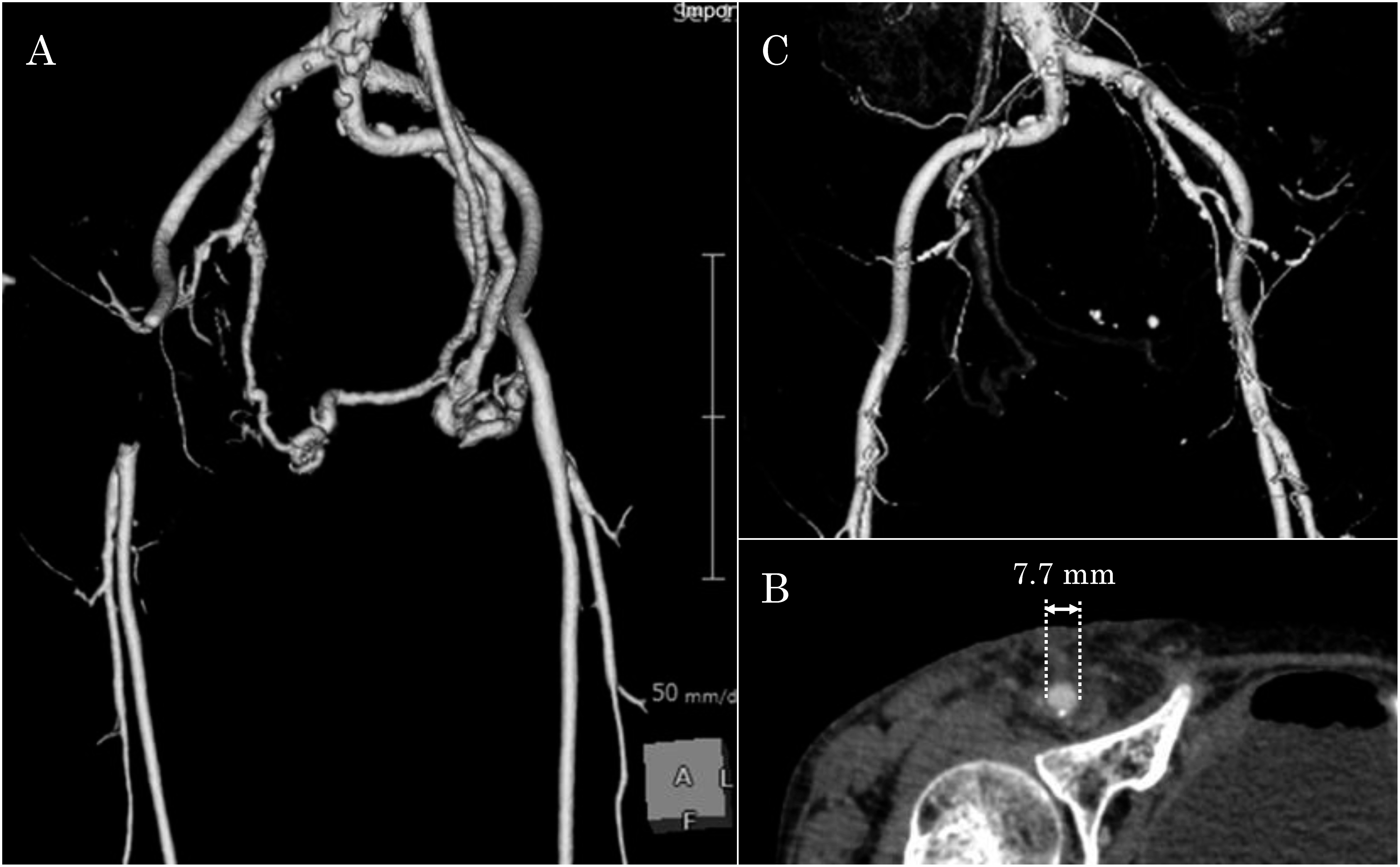 Iatrogenic Common Femoral Artery Occlusion Caused By A Suture Mediated Closure System A Case