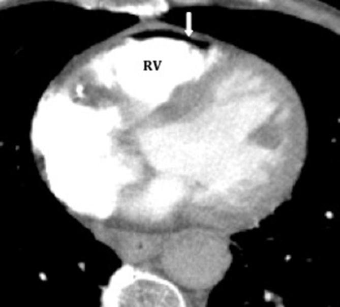 Pictorial Review Non anatomical Cardiovascular Gas Causes pictorial-review-non-anatomical-cardiovascular-gas-causes