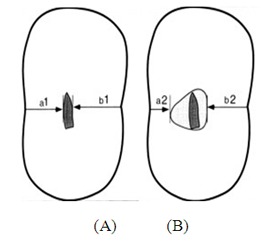 Fig. I: DIAGRAMMATIC REPRESENTATION SHOWING MEASURESENTS FOR IMAGE CROSS SECTIONS:(A) Uninstrumented CT Scan   (B) Instrumented CT Scan.