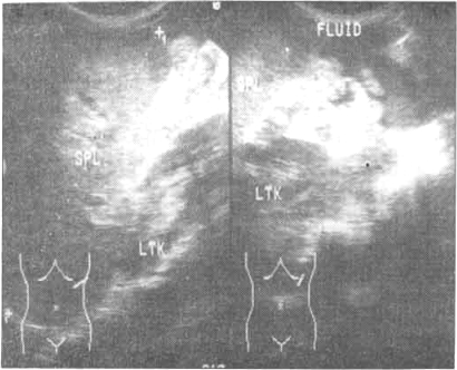 Figure II a
