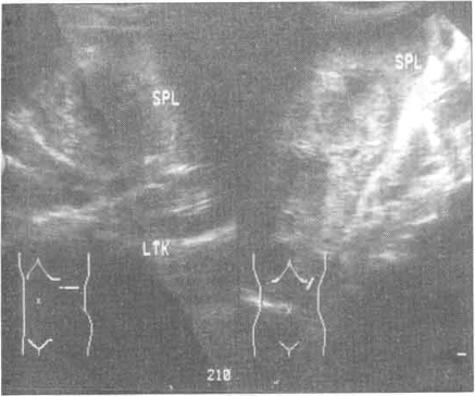 Figure II b
