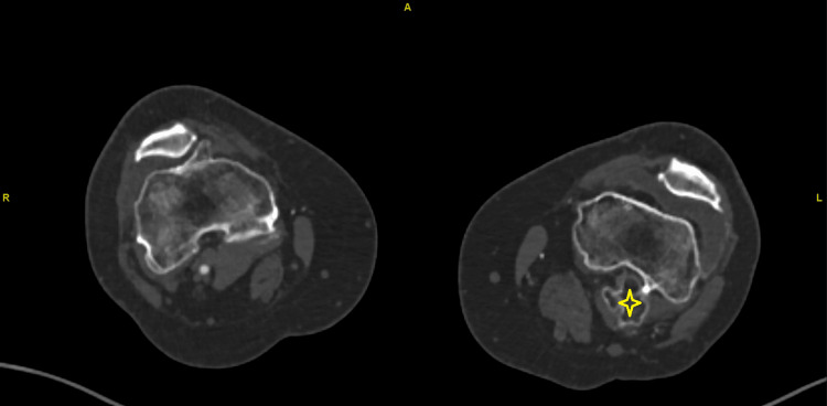 Popliteal Artery Occlusion Due to Femur Exostosis in a Patient With ...