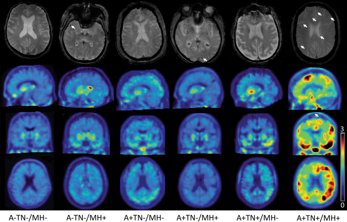 Images in representative participants from each amyloid β/tau/neurodegeneration (ATN) group. The upper row shows axial T2* gradient-echo images with (arrows) and without microhemorrhage. The second, third, and fourth row show sagittal, coronal, and axial fluorine 18–labeled flortaucipir tau PET standardized uptake value ratio (SUVR) images, respectively, normalized to cerebellum gray matter in a SUVR range 3–0. A+ = amyloid β positive, A− = amyloid β negative, TN+ = tau/neurodegeneration positive, TN− = tau/neurodegeneration negative, MH− = microhemorrhages absent, MH+ = microhemorrhages present.