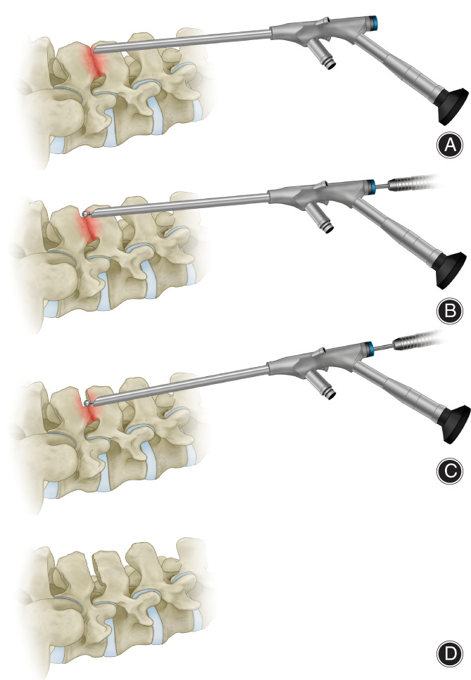 Full‐Endoscopic Approach Forchronic Low Back Pain from Baastrup's ...