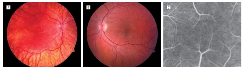 Visual Insignificance of the Foveal Pit: Reassessment of Foveal ...