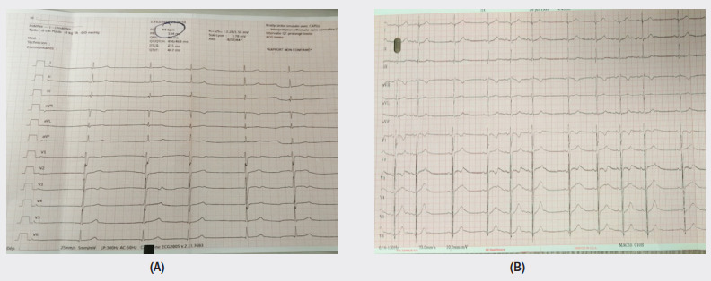  First electrocardiogram (A) showing an atrial sinus block 2/1 (calibration 25mm/s, 5mm/mV) and Second ECG (B) after deep breating (calibration 25mm/s, 10mm/mV)
