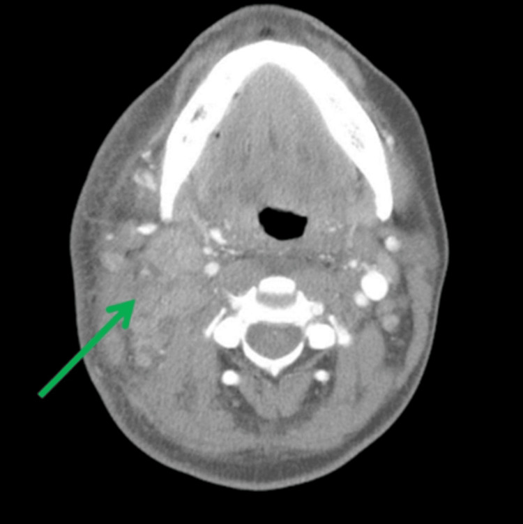 Metastatic Lung Adenocarcinoma Diagnosed By Thyroid Biopsy A Case Report Pmc