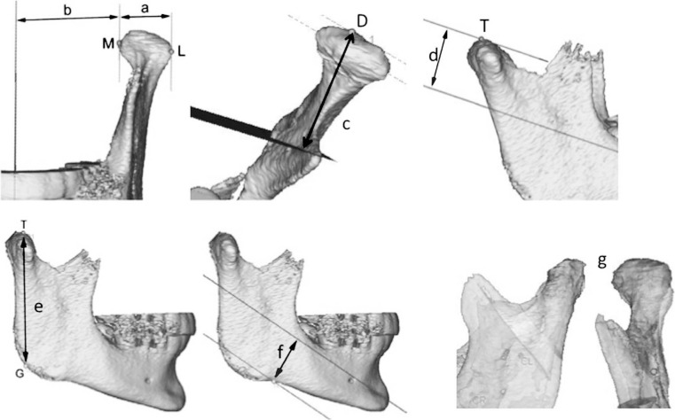 Figure 2. Overview of the measured distances between: (a) the most lateral (L) and most medial (M) points of the condylar head (CW); (b) M and sagittal plane (TD); (c) the most distal (d) point of the condylar head and transverse plane (DD); (d) the most coronal (t) point of the condylar head and axial plane (VD); (e) T and the gonion (g) point (RL); (f) the deepest point of the mandibular body and axial plane (ND). (g) In addition, the differences in condylar volume at T0 and T1 were measured (CV).