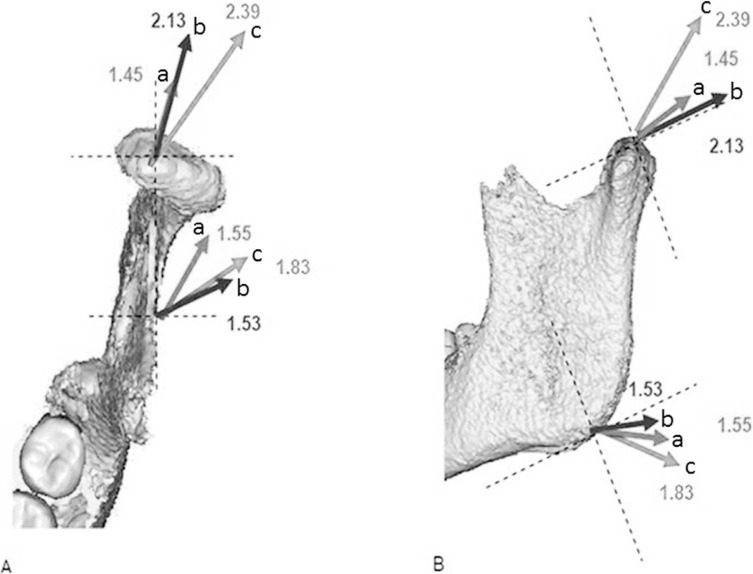 Figure 4. Growth vectors for the top of the condyle and the gonion. (a) JIA affected side, (b) JIA nonaffected side, and (c) non-JIA.