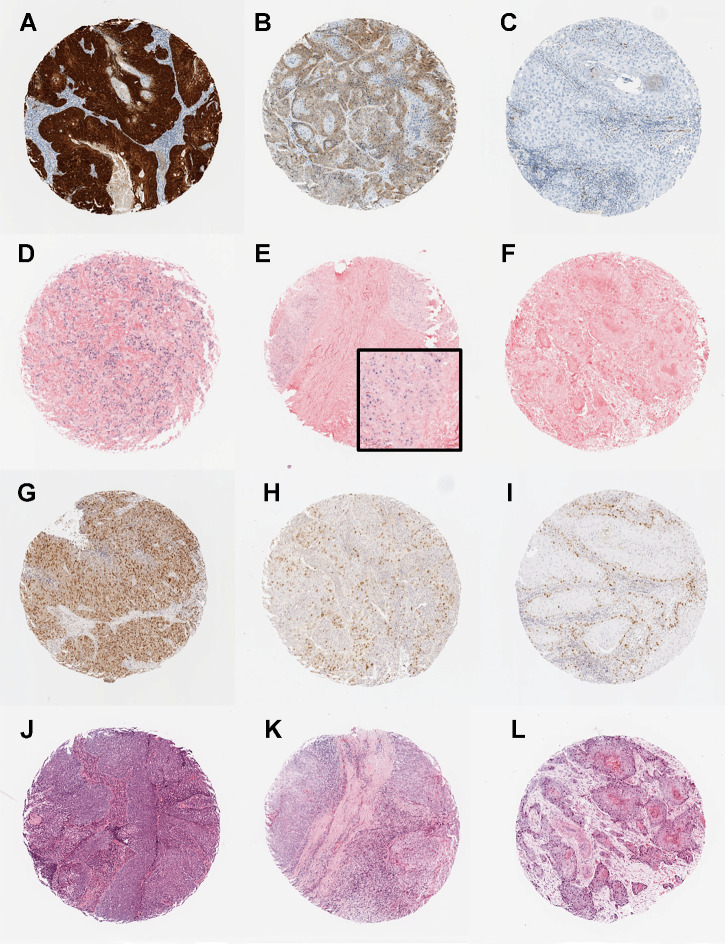 Figure 1. Photomicrographs showing examples of the biomarkers in the predictive classifier: p16 immunohistochemistry (A–C), high-risk HPV in situ hybridization (D–F), survivin immunohistochemistry (G–I), and TILs (J–L). A, p16-positive tumor showing strong and diffuse nuclear and cytoplasmic staining. B, p16-negative tumor showing weak and diffuse cytoplasmic staining. C, p16-negative tumor with no staining. D–E, High-risk HPV-positive tumors showing diffuse nuclear and cytoplasmic staining (D) and punctate nuclear staining (E). F, High-risk HPV-negative tumor with no staining. G–I, Survivin staining showing tumors with high (G), medium (H), and low (I) H-scores. J–L, Cases with high (J), moderate (K), and low (L) TILs.